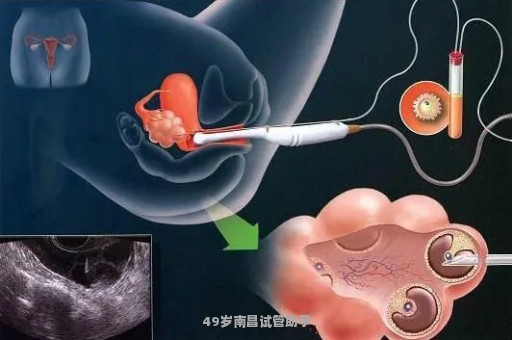 49岁南昌试管助孕
