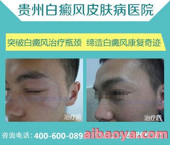 贵州白癜风专科医院官网是什么_简介_专家挂号